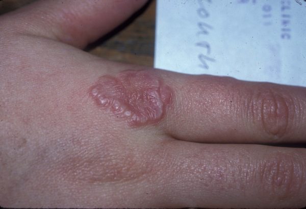 Granuloma Annulare Rash: The Condition and Treatment Options