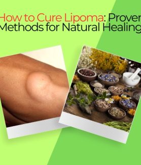 How to Cure Lipoma