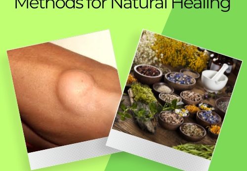 How to Cure Lipoma