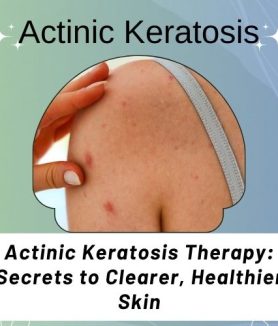 Actinic Keratosis Therapy