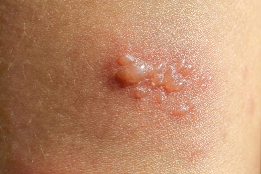 Foods to Avoid with Bullous Pemphigoid: What to Cut Out Today - Herbal