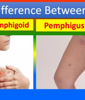 Bullous Pemphigoid and Pemphigus Vulgaris