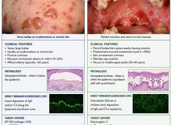 Bullous Pemphigoid vs Pemphigus Vulgaris
