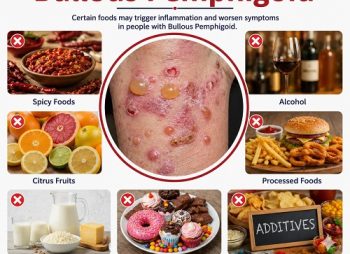 Foods to Avoid with Bullous Pemphigoid