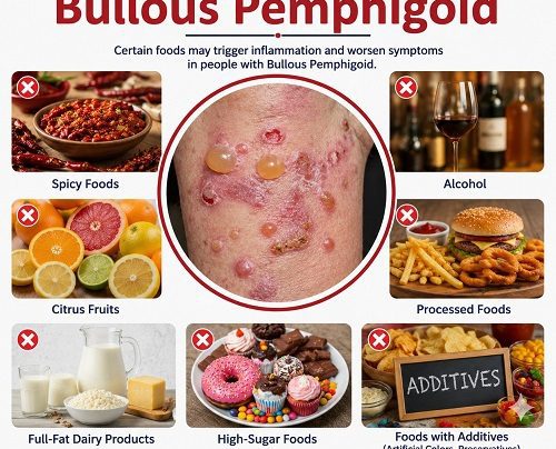 Foods to Avoid with Bullous Pemphigoid