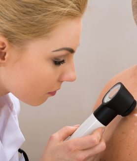 Laser Treatment for Actinic Keratosis