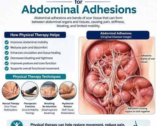 Physical Therapy for Abdominal Adhesions