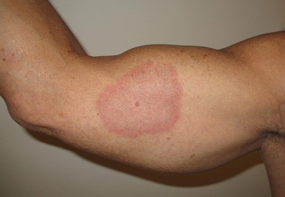 Best Vitamins for Granuloma Annulare