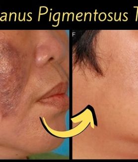 Lichen Planus Pigmentosus