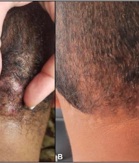 folliculitis keloidalis nuchae_