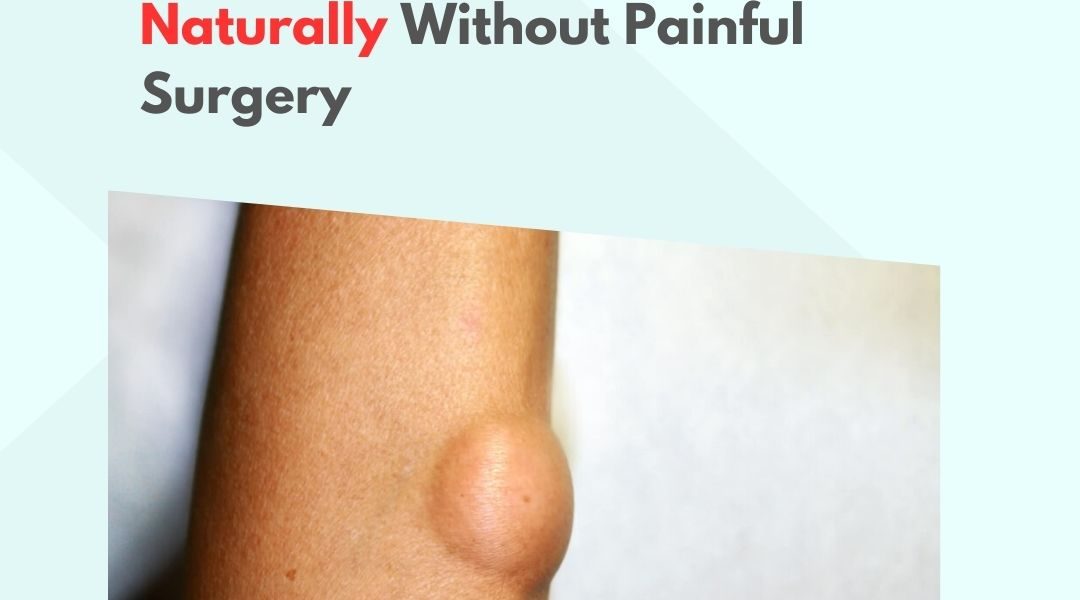 How to Remove Lipoma Naturally Without Painful Surgery