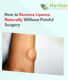 How to Remove Lipoma Naturally Without Painful Surgery