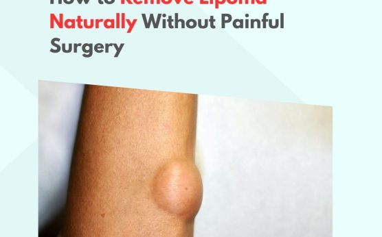 How to Remove Lipoma Naturally Without Painful Surgery