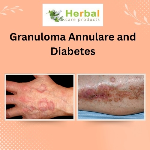 Granuloma Annulare and Diabetes: What You Need to Know About the Connection