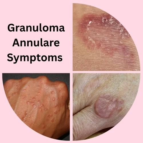 How to Spot Granuloma Annulare Symptoms Early: A Clear Patient Guide