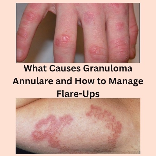 What Causes Granuloma Annulare and How to Manage Flare-Ups