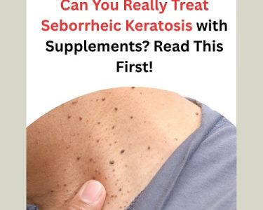 Can You Really Treat Seborrheic Keratosis