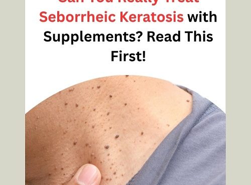 Can You Really Treat Seborrheic Keratosis