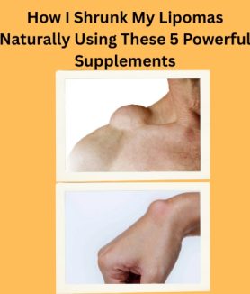 How I Shrunk My Lipomas Naturally (1)