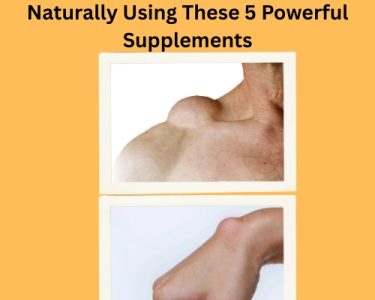 How I Shrunk My Lipomas Naturally (1)