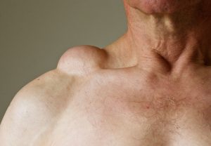 Lipoma Supplements