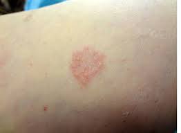 What Causes Granuloma Annulare
