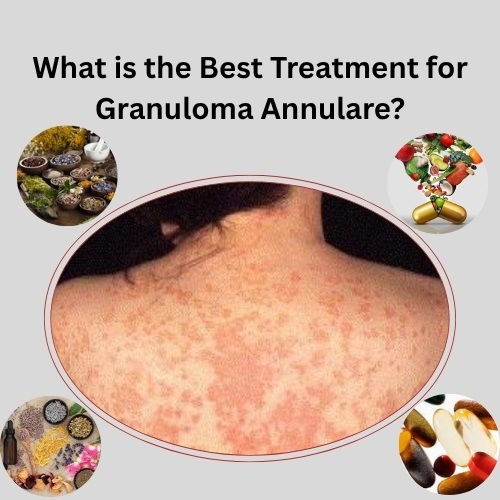 What is the Best Treatment for Granuloma Annulare?