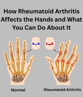 How Rheumatoid Arthritis Affects the Hands