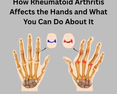 How Rheumatoid Arthritis Affects the Hands