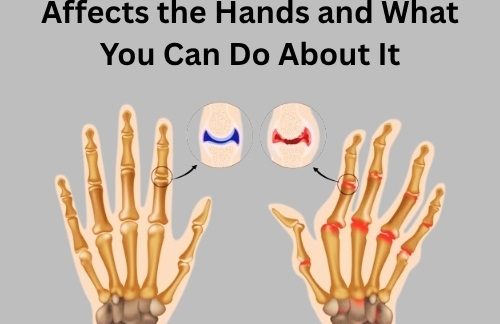 How Rheumatoid Arthritis Affects the Hands