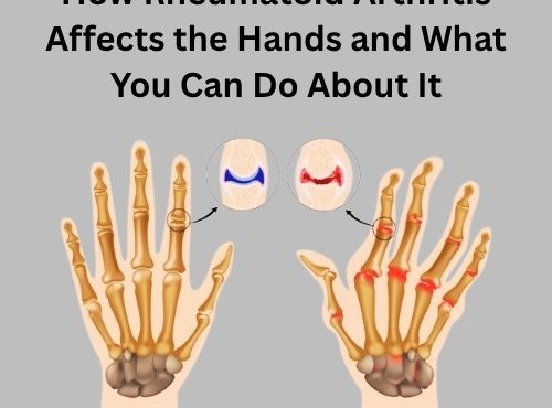 How Rheumatoid Arthritis Affects the Hands