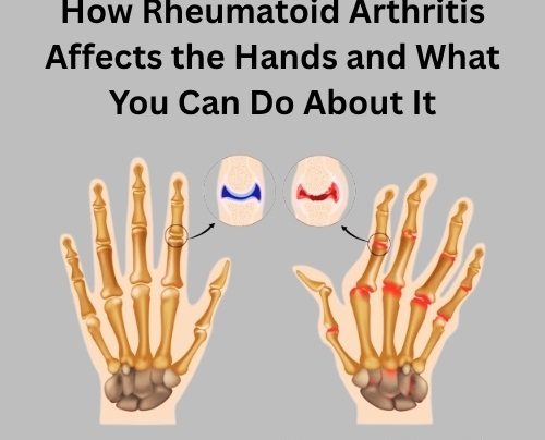 How Rheumatoid Arthritis Affects the Hands