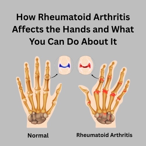 How Rheumatoid Arthritis Affects the Hands and What You Can Do About It