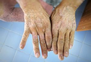 Scleroderma