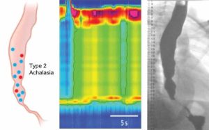 Achalasia Type II