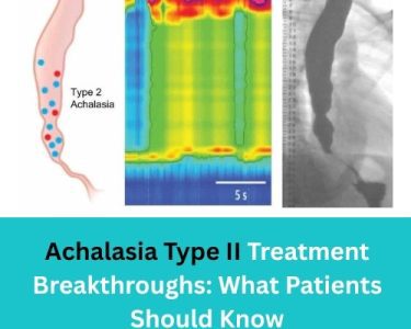 Achalasia Type II Treatment Breakthroughs