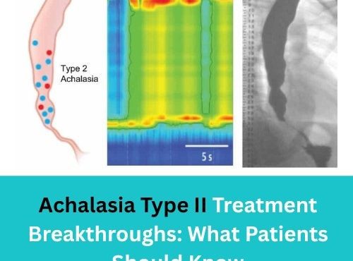 Achalasia Type II Treatment Breakthroughs