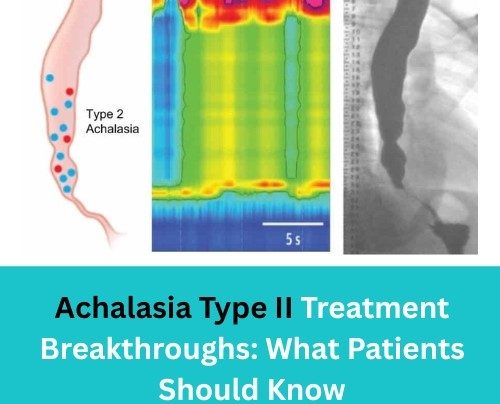 Achalasia Type II Treatment Breakthroughs