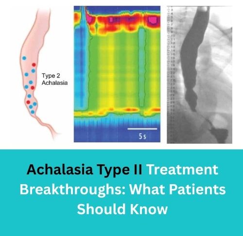 Achalasia Type II Treatment Breakthroughs