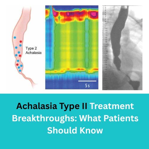 Achalasia Type II Treatment Breakthroughs: What Patients Should Know
