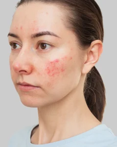 Actinic Keratosis