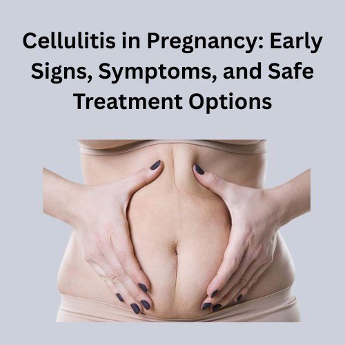Cellulitis in Pregnancy: Early Signs, Symptoms, and Safe Treatment Options