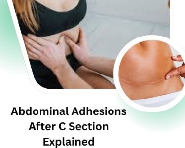Abdominal Adhesions After C Section