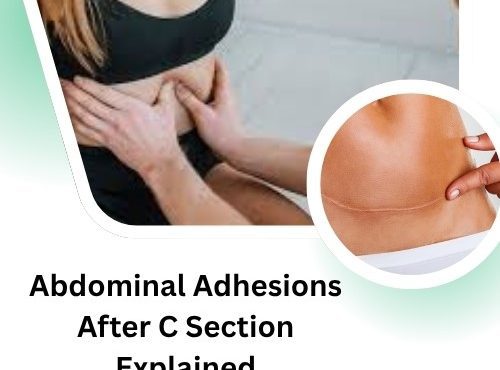 Abdominal Adhesions After C Section