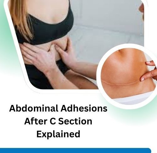 Abdominal Adhesions After C Section