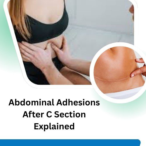 Abdominal Adhesions After C Section Explained: Symptoms, Causes, and Treatments