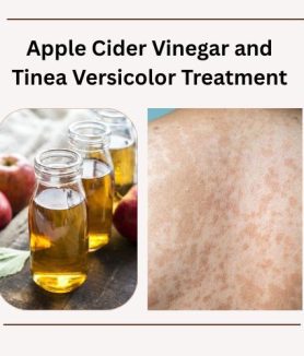 Apple Cider Vinegar and Tinea Versicolor