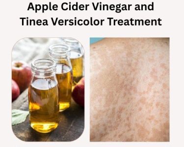 Apple Cider Vinegar and Tinea Versicolor