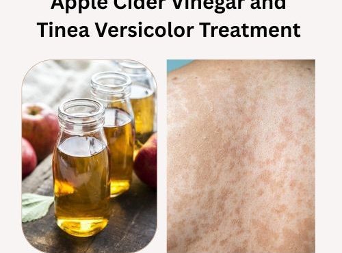 Apple Cider Vinegar and Tinea Versicolor
