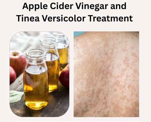 Apple Cider Vinegar and Tinea Versicolor